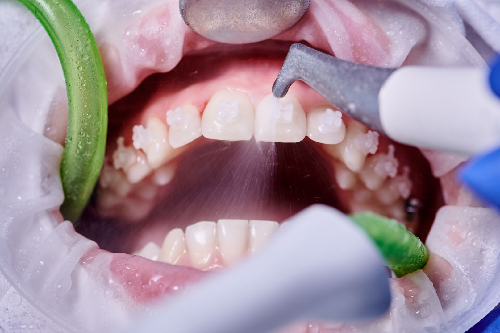 Quanto tempo dura uma limpeza feita pelo dentista